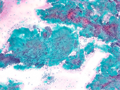 Amyloid goiter: abundant amyloid with embedded fibroblasts.
Keywords: Amyloid Goiter