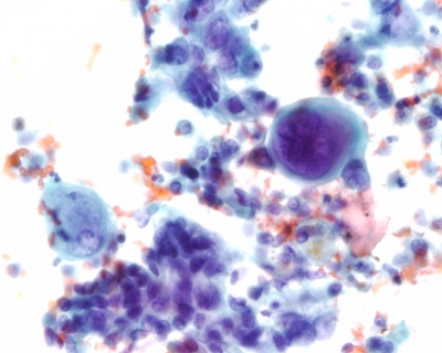 Pleomorphic malignant cells, isolated and in tissue fragments.
Keywords: Anaplastic Carcinoma