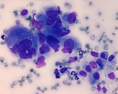 Anaplastic Carcinoma of Thyroid
Keywords: Anaplastic Carcinoma