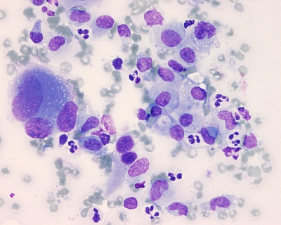 Romanowsky-stained poorly differentiated cells.
Keywords: Anaplastic Carcinoma