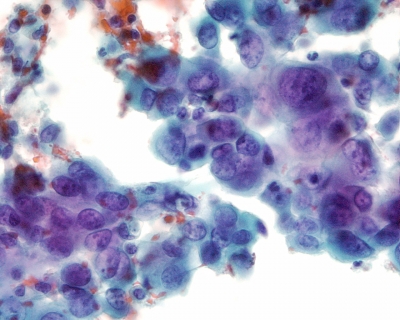 Malignant cells with extreme pleomorphism.
Keywords: Anaplastic Carcinoma