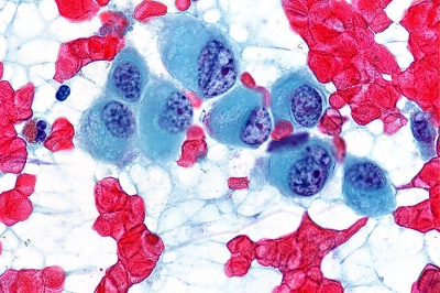 Large epithelioid malignant cells.
Keywords: Undifferentiated, Anaplastic, Carcinoma
