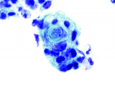 Small pearl (ThinPrep).
Keywords: Primary Mucoepidermoid Carcinoma
