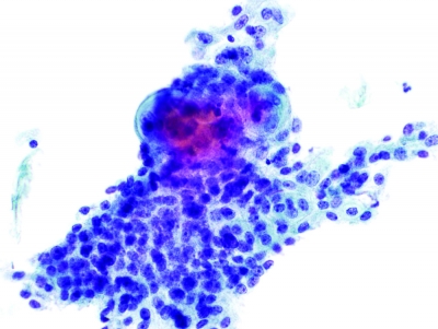 Intermediate-type cells and small keratin pearls (ThinPrep).
Keywords: Primary Mucoepidermoid Carcinoma
