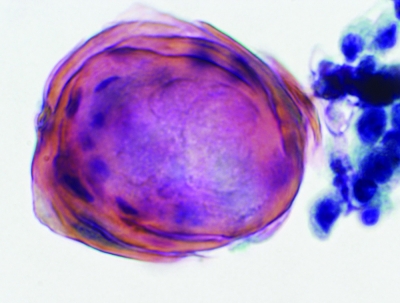 Large keratin pearl (ThinPrep).
Keywords: Primary Mucoepidermoid Carcinoma, Squamous Pearl