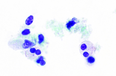 Glandular-type cells and occasional eosinophils (ThinPrep).
Keywords: Primary Mucoepidermoid Carcinoma