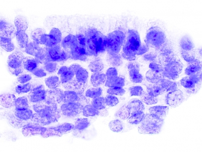PTC, Columnar Cell Variant.
These cells are more crowded and have less cytoplasm than those of the tall cell variant.
Keywords: Papillary Carcinoma, liquid based, ThinPrep, Columnar Cell