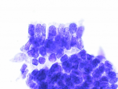 PTC, Columnar Cell Variant.
The crowded columnar orientation is apparent.
Keywords: papillary Carcinoma, liquid based, ThinPrep, Columnar Cell