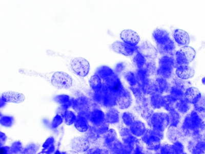 PTC, Columnar Cell Variant.
Columnar cells are clearly visible along the edge.
Keywords: Papillary Carcinoma, liquid based, ThinPrep, Columnar Cell