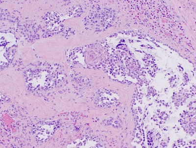 Histologic section.
Keywords: Primary Mucoepidermoid Carcinoma of Thyroid Histology
