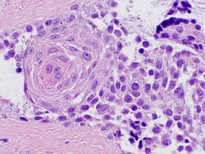 Histologic section.
Keywords: primary Mucoepidermoid Carcinoma of Thyroid Histology