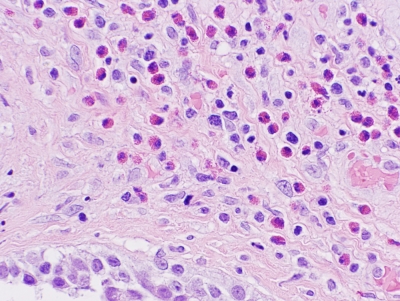 Histologic section.
Keywords: Primary Mucoepidermoid Carcinoma of Thyroid Histology