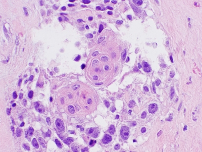 Histologic section.
Keywords: Primary Mucoepidermoid Carcinoma of Thyroid Histology
