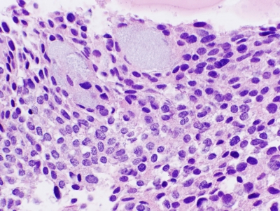 Histologic section.
Keywords: Primary Mucoepidermoid Carcinoma of Thyroid Histology