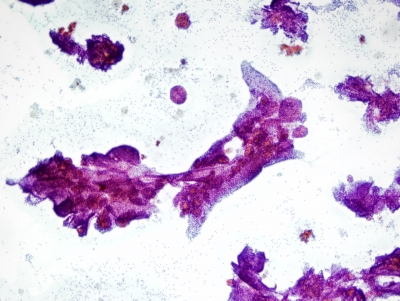 Benign adenomatous hyperplasia
Benign hyperplasia in follicular nodule
Keywords: Adenomatous hyperplasia, benign follicular nodule