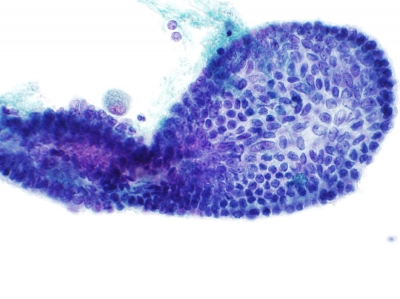 Intact papilla.
Keywords: Papillary Carcinoma, liquid based, ThinPrep