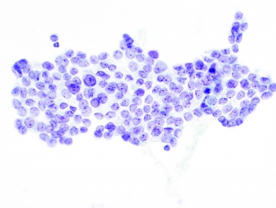 Monolayered sheet.
Keywords: Papillary Carcinoma, liquid based, ThinPrep