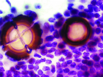 Psammoma bodies.


Keywords: Papillary Carcinoma, Psammoma body, liquid based, ThinPrep