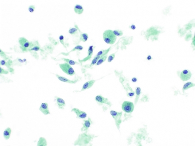 Spindle-shaped and plasmacytoid cells (ThinPrep).
Keywords: Medullary Carcinoma, spindle cells, plasmacytoid cells