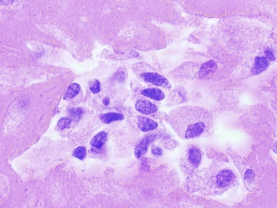 Spindle-shaped and epithelioid cells (cell block).
Keywords: Undifferentiated, Anaplastic, Carcinoma, Cell Block
