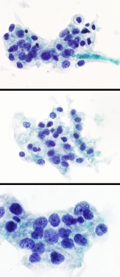 Metastatic renal cell carcinoma (ThinPrep).
Keywords: RCC, Renal Cell Carcinoma, Metastatic Carcinoma