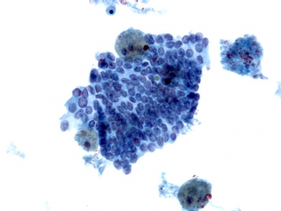 Papillary Carcinoma of Thyroid - Cystic Variant (ThinPrep).
Keywords: Papillary Thyroid Carcinoma, Cystic Variant (PTC CV), Liquid Based, ThinPrep