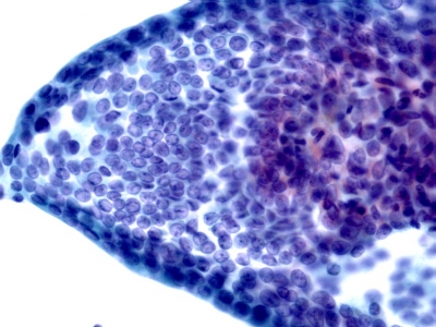 Papillary Carcinoma of Thyroid - Cystic Variant
Keywords: Papillary Thyroid Carcinoma, Cystic Variant (PTC CV)