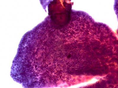 Papillary Carcinoma of Thyroid - Cystic Variant
At times the abnormal cells may be hard to find because of the dilutional effect of large volumes of cystic fluid.
Keywords: Papillary Thyroid Carcinoma, Cystic Variant (PTC CV)