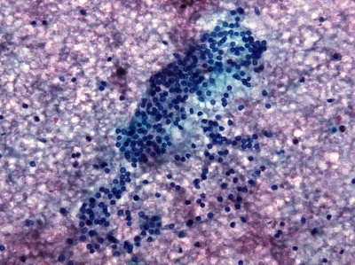 Thyroglossal duct cyst: sheet of benign epithelial cells from cyst wall (Pap stain).
Keywords: Thyroglossal Duct Cyst, Cyst Fluid