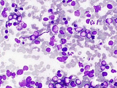 Diffuse large B cell lymphoma.
Keywords: Diffuse large B cell lymphoma, NHL, Non-hodgkin lymphoma