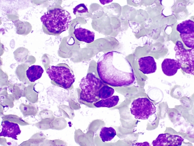 Diffuse large B cell lymphoma.
Keywords: Diffuse large B cell lymphoma, NHL, Non-hodgkin lymphoma