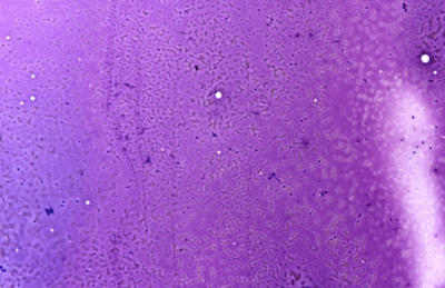 Pure colloid
Keywords: Colloid nodule, colloid