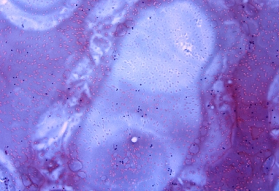 Abundant colloid.
Keywords: Abundant colloid (Diff Quik).