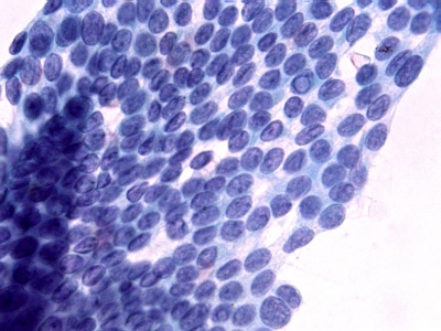 Grooves and intranuclear pseudoinclusions (INCIs).
Keywords: Grooves and Nuclear pseudoinclusions (INCI)