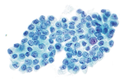 Monolayered sheet with grooves and intranuclear pseudoinclusions.
Keywords: Papillary Carcinoma, liquid based, ThinPrep