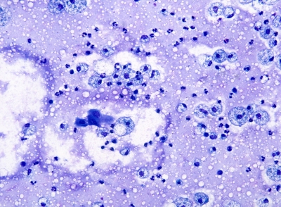 Thyroglossal duct cyst: histiocytes and squames (smear, Diff Quik stain).
Keywords: Thyroglossal Duct Cyst, Cyst Fluid
