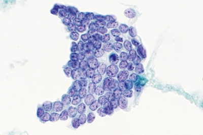 Monolayered sheet.
Keywords: Papillary Carcinoma with Powdery Chromatin