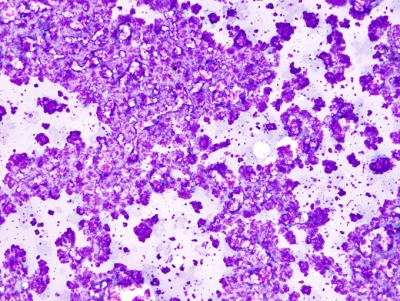 Unsatisfactory due to precipitated stain.
The whole sample is obscured by precipitated stain. 
This occurs with some frequency when using Romanowsky type stains.
Keywords: precipitated stain, unsatisfactory
