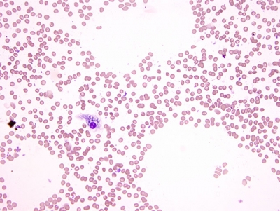 Non-diagnostic; blood and rare macrophages only.
No follicular epithelial cells present.
Keywords: Unsatisfactory, blood, non-diagnostic