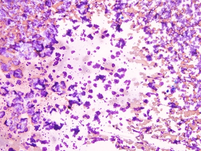 Unstatisfactory; blood and precipitated stain only.
Keywords: Precipitated stain, unsatisfactory, non-diagnostic