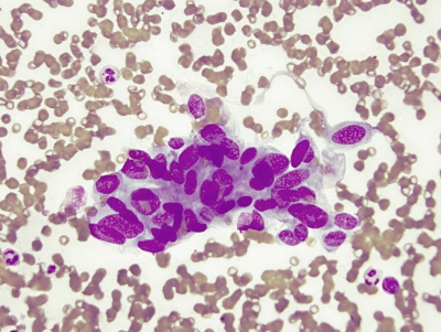 Oval, elongated, overlapping nuclei.
Keywords: Papillary Carcinoma, Overlapping Nuclei