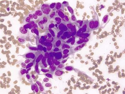 Pleomorphic, elongated, overlapping nuclei.
Keywords: Papillary Carcinoma, Overlapping Nuclei