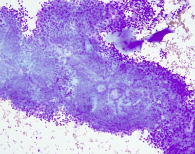 Three dimensional sheet of benign follicular cells plus thick colloid.
Keywords: Cellular goiter, adenomatoid nodule, hypercellular colloid nodule
