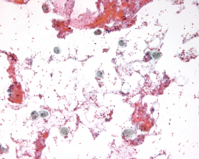 Blood and macrophages
Keywords: Cyst Fluid
