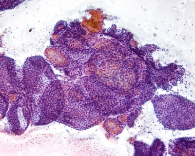 Benign follicular cells in macrofollicles.
Keywords: Benign follicular cells in macrofollicles.