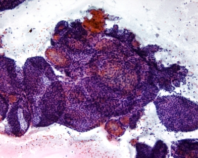 Benign adenomatous hyperplasia
Adenomatous hyperplasia in a benign follicular nodule. The three dimensional structures are acini and not papillary groups.
Keywords: Adenomatous hyperplasia, benign follicular nodule