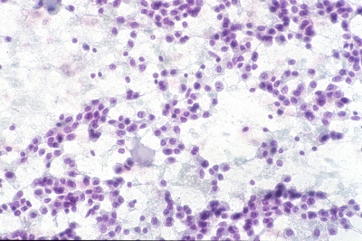 Monomorphic population of plasmacytoid cells with amyloid.
Keywords: Medullary, Carcinoma, 