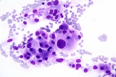 Epithelioid cells with anisonucleosis and red cytoplasmic granules. Amyloid is present.
Keywords: Medullary, Carcinoma, Neuroendocrine