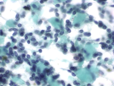Fusiform (spindle-shaped) cell pattern with abundant amyloid.
Keywords: Medullary, Carcinoma, Neuroendocrine, Spindle Cells