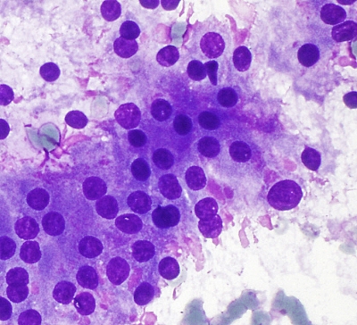 Flame Cells in Grave's Disease
Stimulated follicular cells in Grave's disease showing abundant cytoplasm and intracytoplasmic accumulation of thyroglobulin producing a pattern reminiscent of "flame".
Keywords: Flame_Cell, Grave's Disease, Hot Nodule